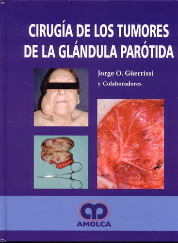 GUERRISSI CIRUGIA DE LOS TUMORES DE LA GLANDULA PAROTIDA, de JORGE A. GUERRISI | portada del libro