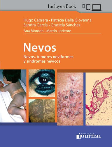 NEVOS NEVOS TUMORES NEVIFORMES Y SINDROMES NEVICOS, de CABRERA | portada del libro