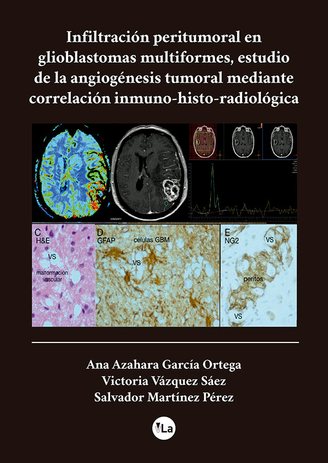 Infiltracion peritumoral en glioblastomas multiformes, estudio de la angiogénesis tumoral mediante c, de García Ortega, Ana A
