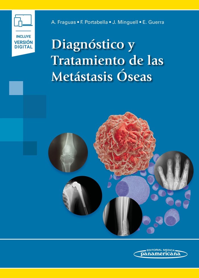 Diagnóstico y Tratamiento de las Metástasis Óseas (incluye versión digital), de Fraguas i Castany, Antonio | portada del libr