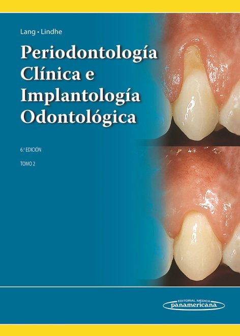 LINDHE:PeriodontologÆa ClÆnica 6a Ed. T2, de LINDHE | portada del libro