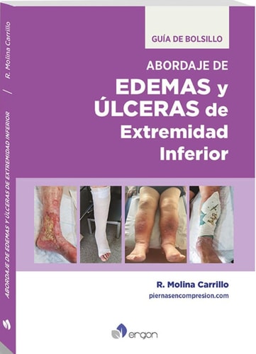 EDEMAS Y ULCERAS DE EXTREMIDAD INFERIOR GUIA DE BOLSILLO, de MOLINA CARRILLO | portada del libro