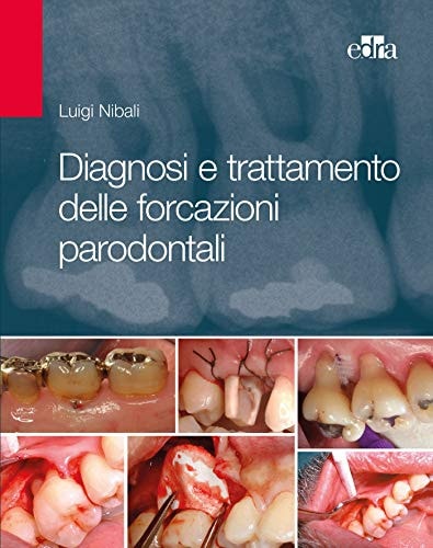 DIAGNOSI E TRATTAMENTO DELLE FORCAZIONI PARODONTALI, de Luigi Nibali | portada del libro