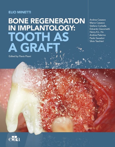 Bone regeneration in implantology:tooth as a graft, de Minetti | portada del libro