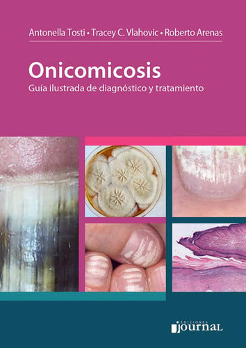 ONICOMICOSIS, de ARENAS | portada del libro