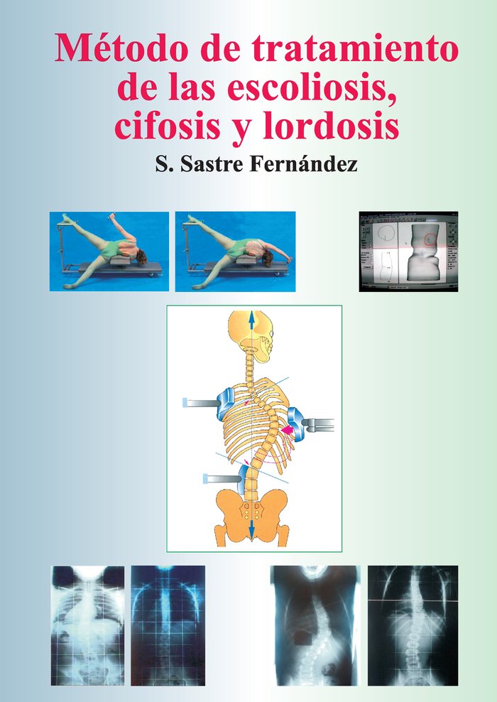 Método de tratamiento de las escoliosis, cifosis y lordosis, de Sastre Fernández | portada del libro