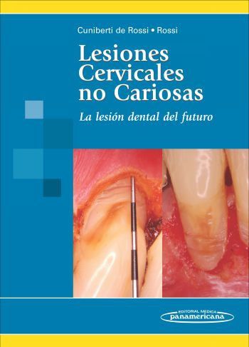 CUNIBERTI:Lesiones Cervicales no Cariosa, de CUNIBERTI DE ROSSI, ROSSI | portada del libro