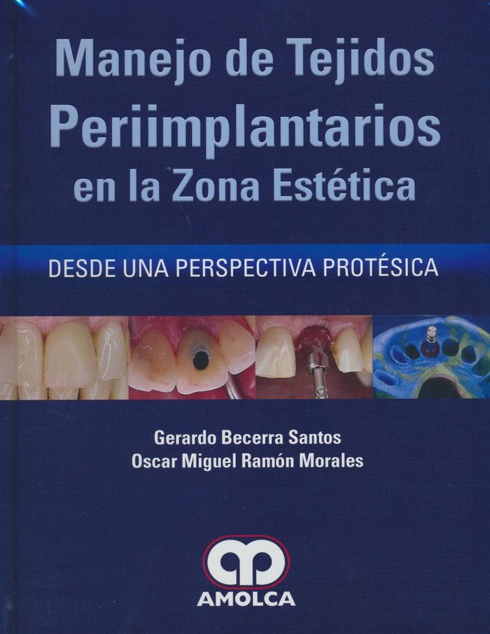 MANEJO DE TEJIDOS PERIMPLANTARIOS EN LA ZONA ESTETICA DESDE, de BECERRA | portada del libro